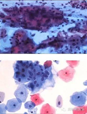 宫颈刮片图片报告单,怎么看宫颈刮片