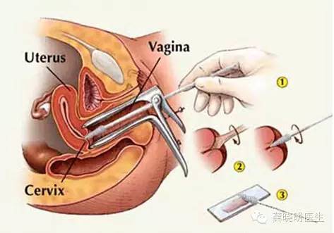 宫颈刮片图片报告单,怎么看宫颈刮片
