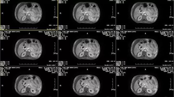 所有检查做完了不知道腹水原因,出现腹水是不是就是晚期了