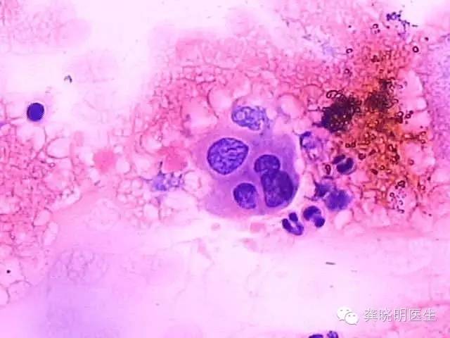 宫颈刮片图片报告单,怎么看宫颈刮片