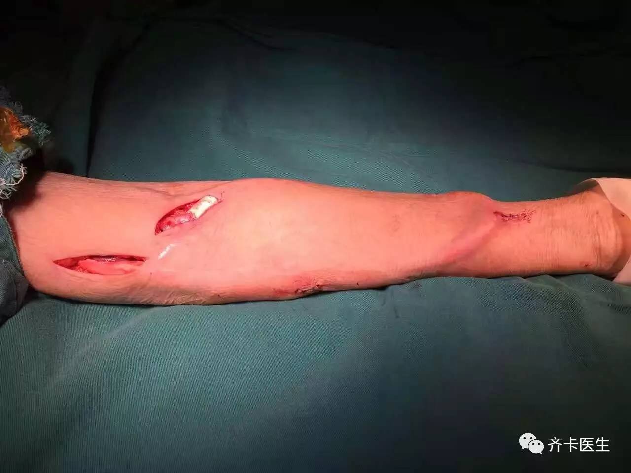 颈部血透导管一般是长期还是临时,颈内静脉临时导管的固定