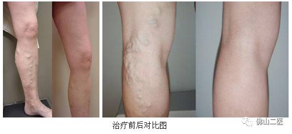 血管迂曲能好转吗,血管弯曲能治好吗