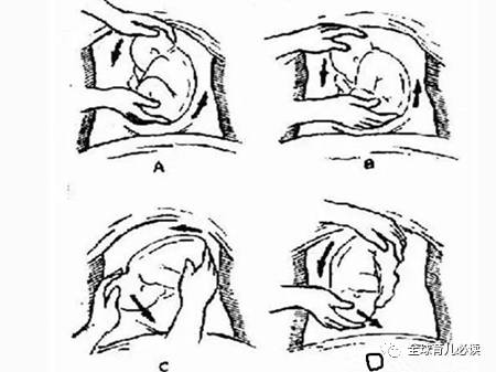 胎位不正婆婆让顺产,顺产胎位不正压肚子