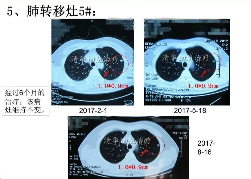 nkt治疗是免疫治疗吗,nkt治疗案例