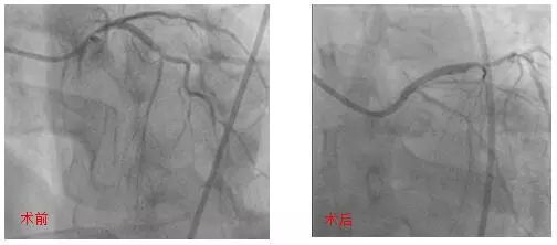 复杂冠状动脉病变,冠状动脉粥样硬化防治
