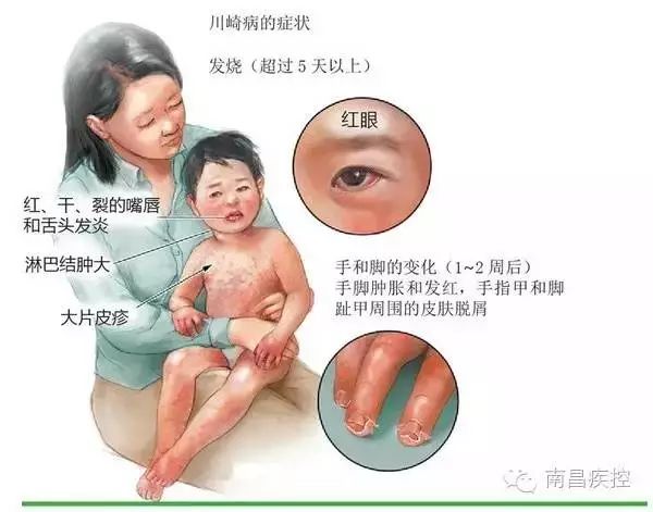 男童得怪病高烧不退,7个月宝宝连续高烧已超过72小时