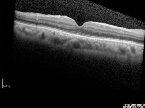 黄斑病变的克星,得了黄斑病变需要忌什么食物