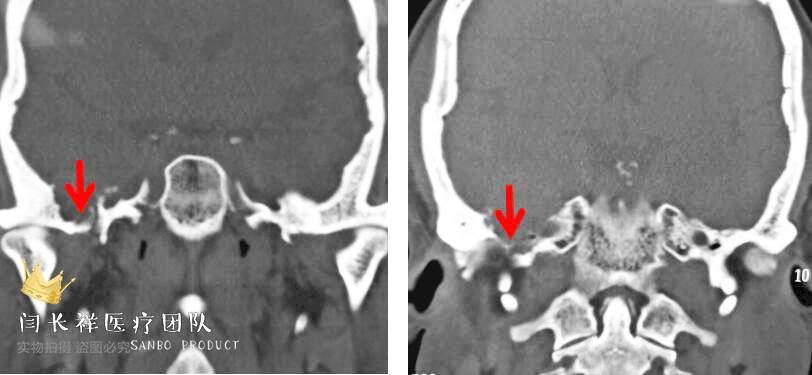烦人的耳鸣,烦人耳鸣