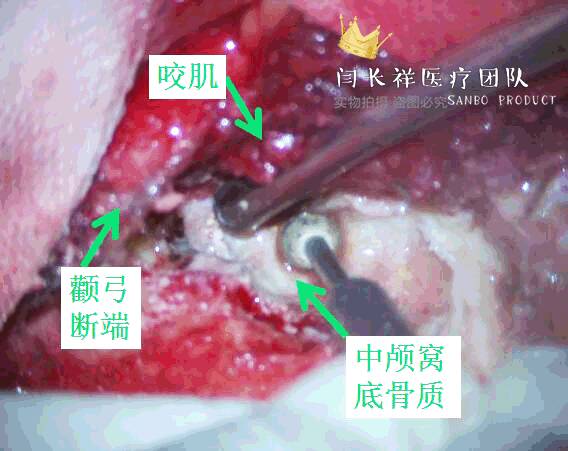 烦人的耳鸣,烦人耳鸣