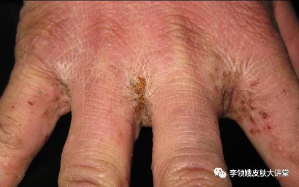 怎样判定身上痒是疥疮,专家治疗皮肤瘙痒症视频