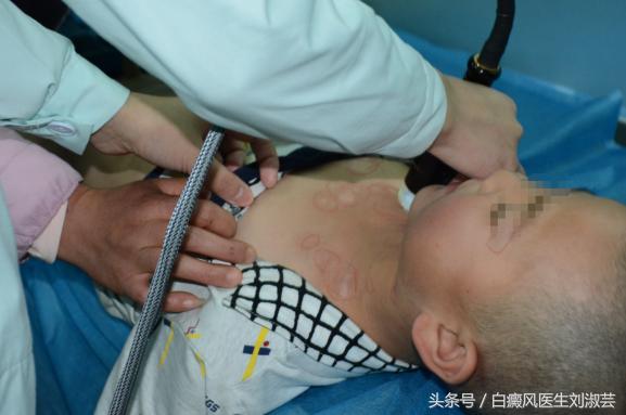 祛白癜风,彻底治疗白癜风的特效药