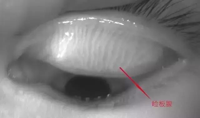 干眼症能工作吗,神经性干眼症自救