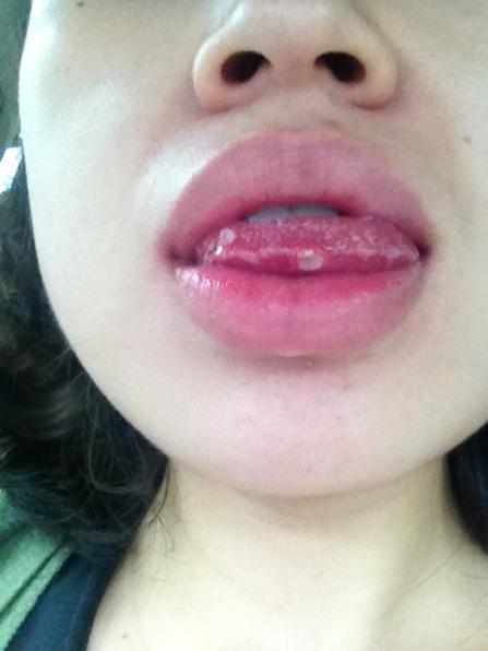 口腔溃疡最特效偏方,治口腔溃疡简单粗暴的方法