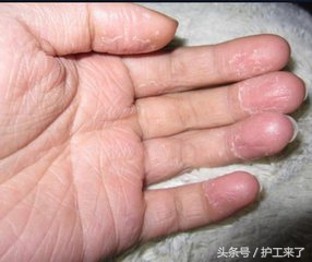 夏季手脱皮怎么办最快最有效方法,一到夏季手又开始脱皮是怎么回事