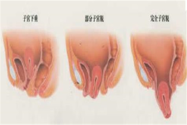 女性经常腰疼，先不要忍，看看是不是这些妇科疾病在捣乱