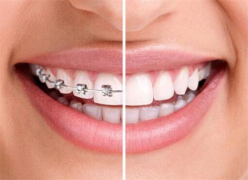 长智齿应该怎么办需要拔掉吗,如果长智齿时前牙已经坏了怎么办