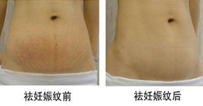 生了宝宝，你的“花肚皮”怎么办？可以这样做！