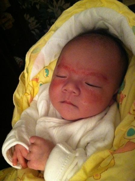 婴儿湿疹反复发作怎么断根,婴儿反复湿疹怎么办