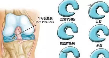 半月板损伤可以跑步锻炼腿肌肉吗,半月板已经损伤了如何跑步