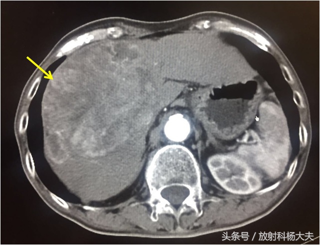 体检中afp是什么项目,体检afp偏高要挂什么科