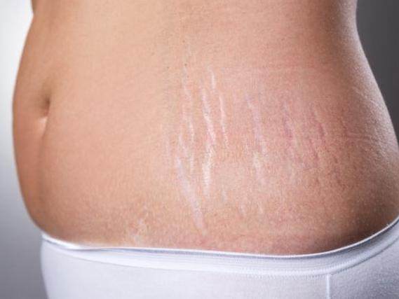 生了宝宝，你的“花肚皮”怎么办？可以这样做！