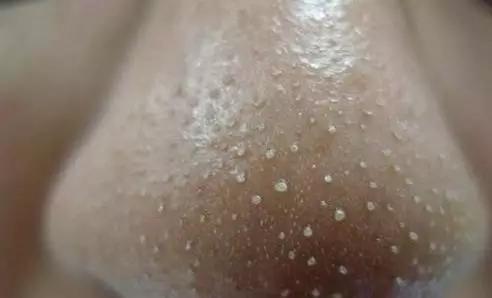 鼻子上挤出的白色分泌物怎么消除,鼻子两侧每天都能挤出白色的东西
