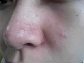 鼻子上挤出的白色分泌物怎么消除,鼻子两侧每天都能挤出白色的东西