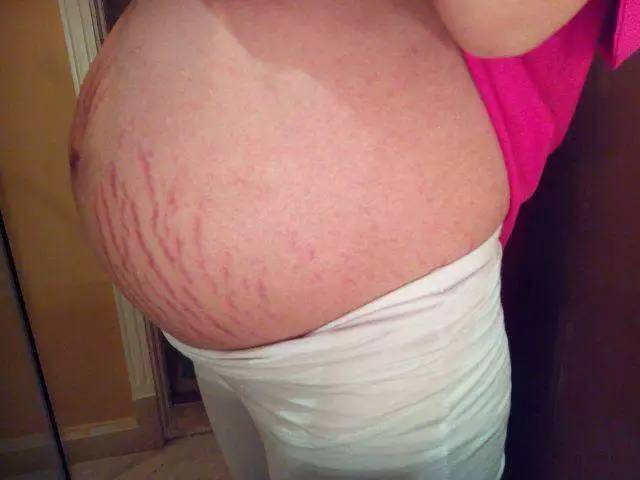 六大方法有效去除妊娠纹！收藏了！