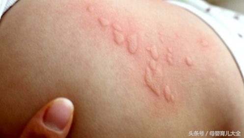 回了趟老家身上起疙瘩,宝宝回老家身上就出疙瘩怎么办