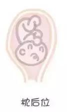 胎位不正怎么纠正胎位,胎位不正做什么动作胎位才正