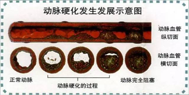 血管堵塞图,我们人体的血管