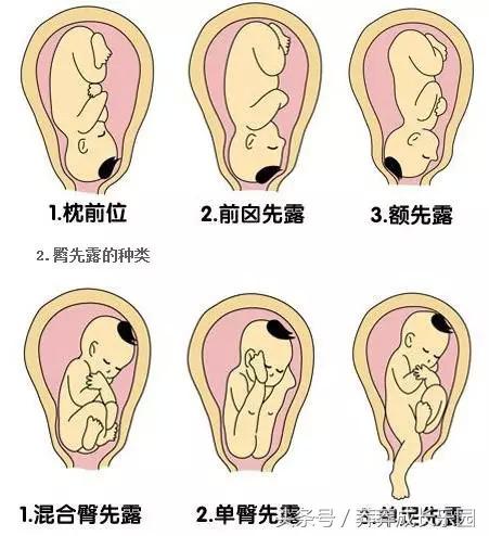 胎位扭转术有什么风险,39周胎位倒转术还可以做吗