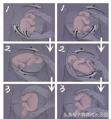 胎位扭转术有什么风险,39周胎位倒转术还可以做吗