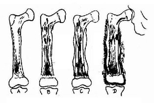 慢性死骨取出术知多少？