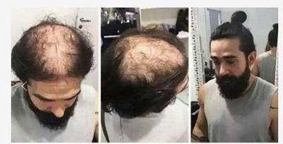 黑科技脱发,国外脱发神器