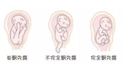 胎位不正怎么纠正胎位,胎位不正做什么动作胎位才正