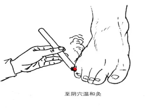 胎位不正怎么纠正胎位,胎位不正做什么动作胎位才正