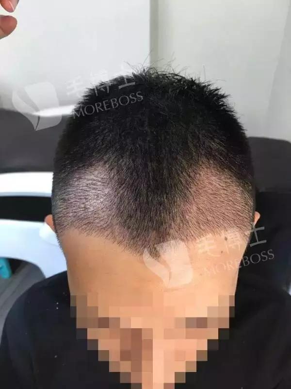 脱发到什么程度要去医院,脱发到什么等级