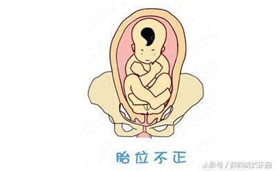 胎位扭转术有什么风险,39周胎位倒转术还可以做吗