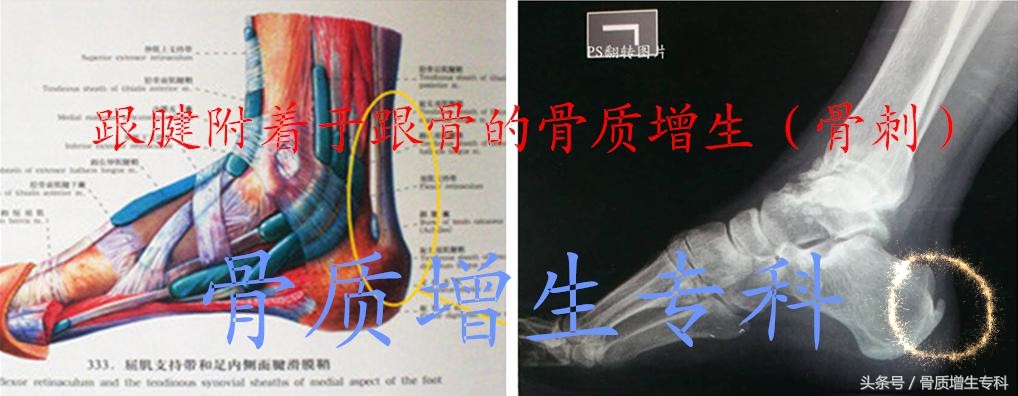 颈椎骨质增生最好的锻炼恢复方法,腰椎2至4节骨质增生应该怎样锻炼