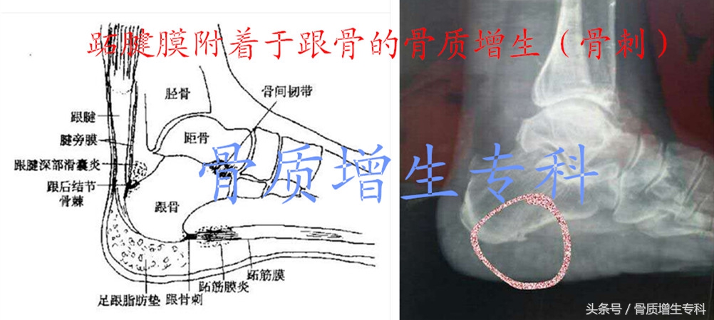 颈椎骨质增生最好的锻炼恢复方法,腰椎2至4节骨质增生应该怎样锻炼