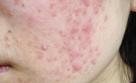 内分泌失调嘴巴附近起痘怎么调理,女性内分泌失调满脸爆痘调理动作