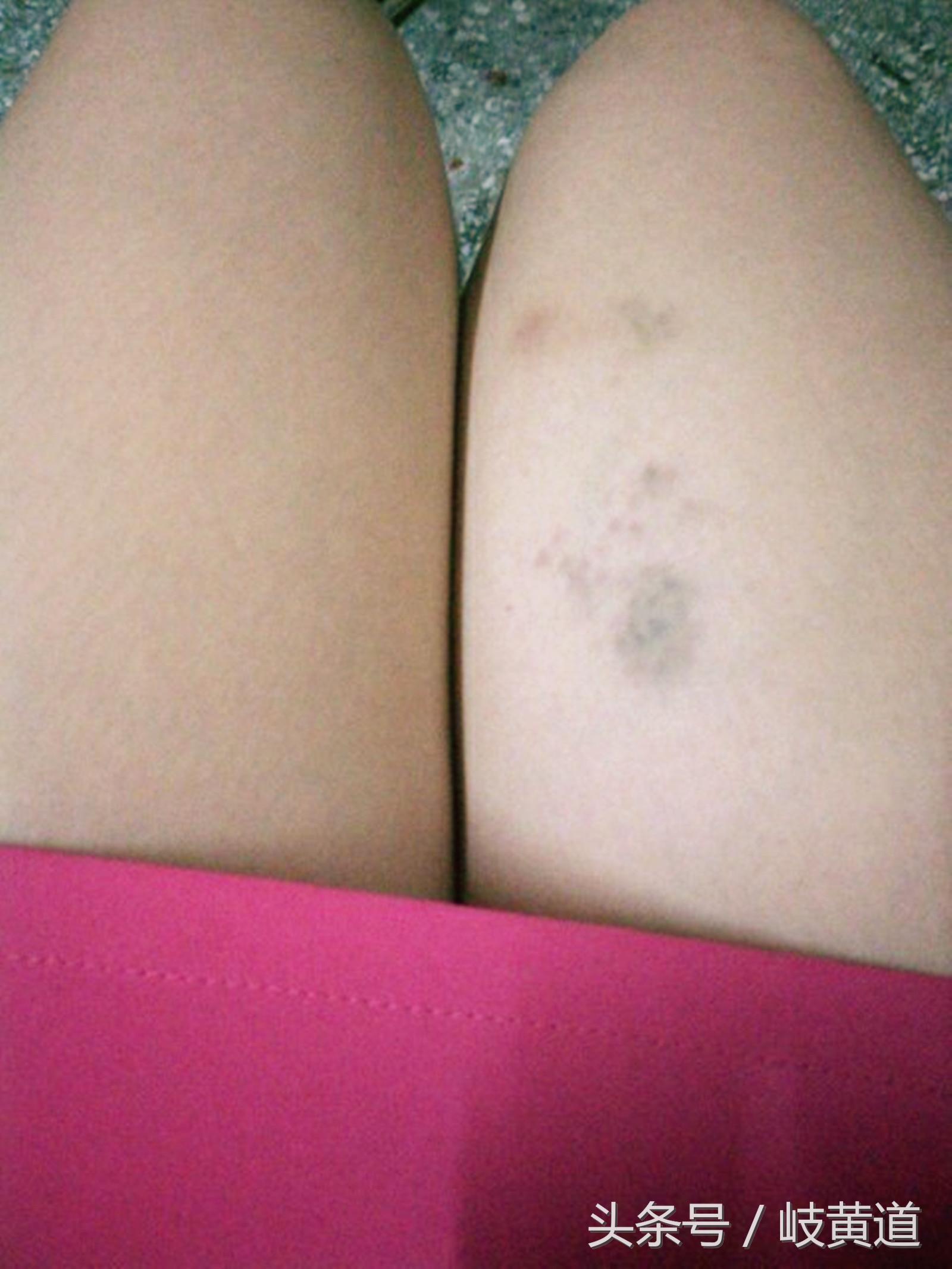 俗话说的鬼捏青是怎么回事,鬼掐青是什么