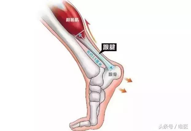 跟腱炎如何才能算是真正的好了,如果有跟腱炎应该怎么样练