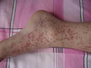 紫癜性肾炎看病记录,治疗紫癜性肾炎的中药有哪些