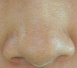 鼻子上挤出的白色分泌物怎么消除,鼻子两侧每天都能挤出白色的东西