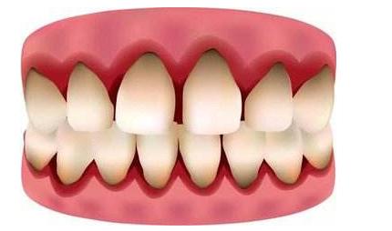 牙龈肿痛怎么治疗最好,治疗牙龈肿痛的中药方