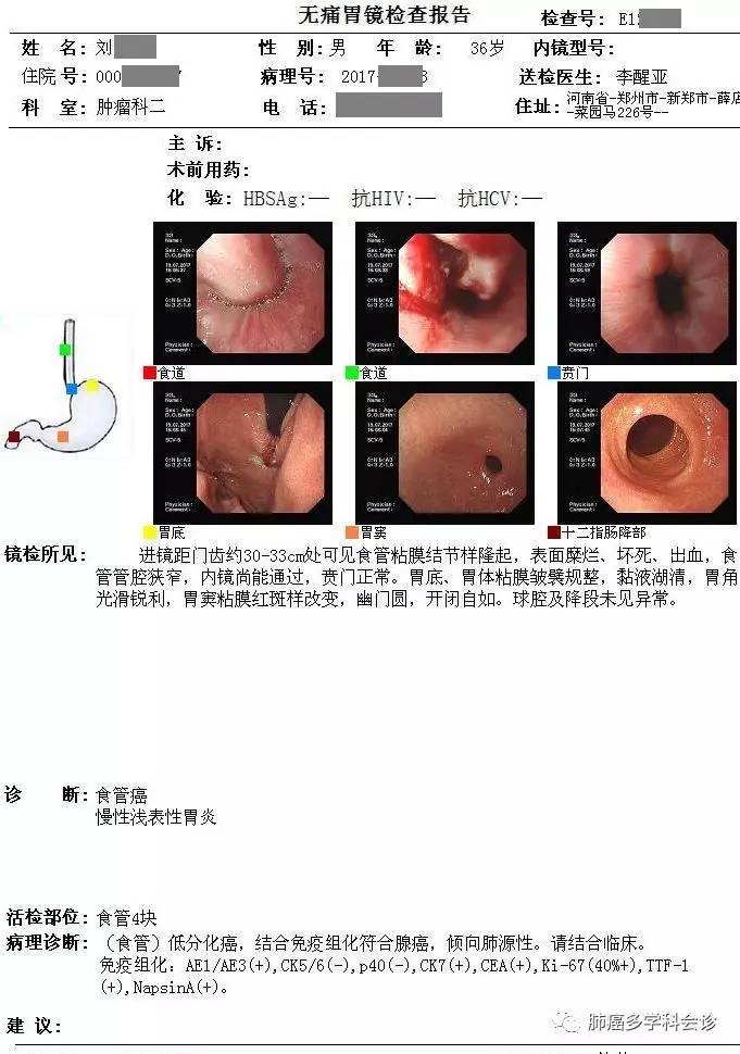食管癌转移两侧淋巴癌严重吗,食管癌转移和扩散区别