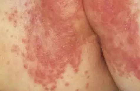 宝宝红屁股是不是老是哭,宝宝红屁股怎么缓解疼痛