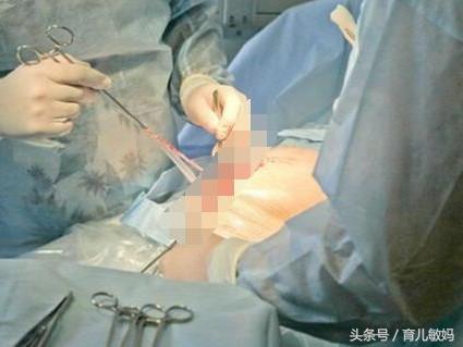 剖腹产41天向前摔了一下有事吗,剖腹产后第二天起床就头晕头疼